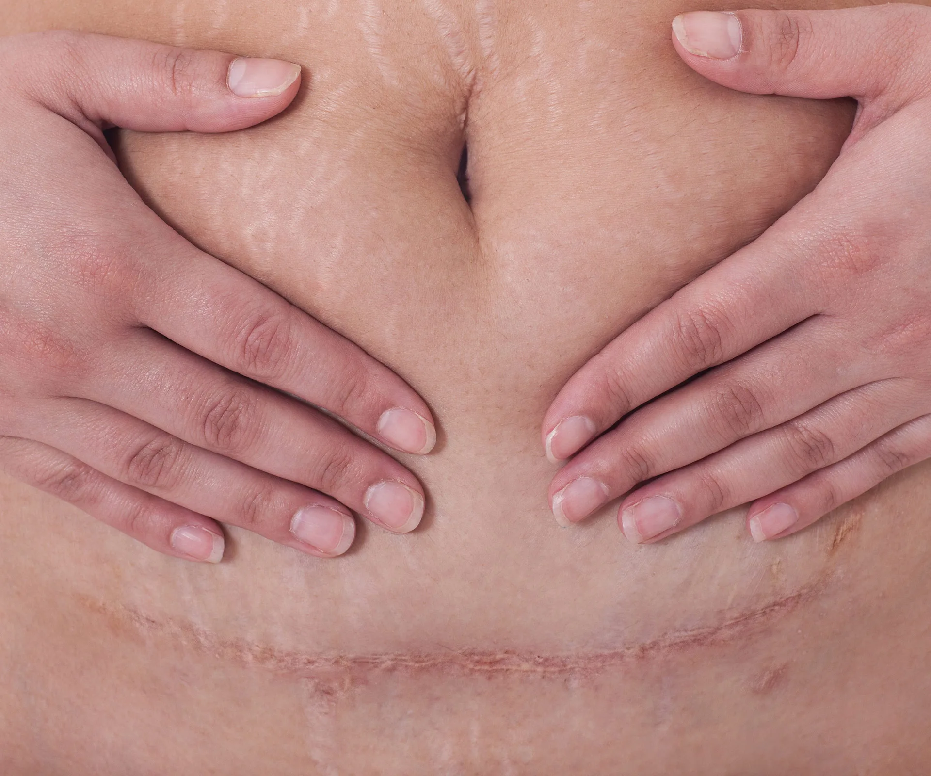 Hands gently covering a healed C-section scar on a person's abdomen.