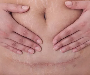 Hands gently covering a healed C-section scar on a person's abdomen.