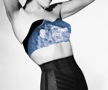Breast density is the biggest cancer risk 