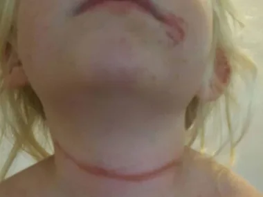 Child's neck with a red mark from strangulation, indicating injury from a cord.