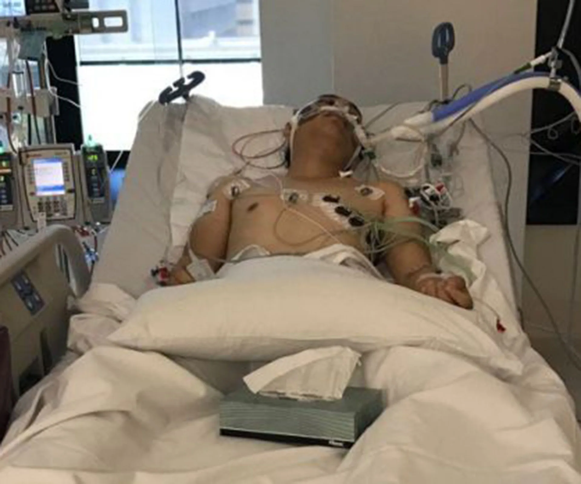 A person with medical equipment is lying in a hospital bed, connected to various monitors and tubes.