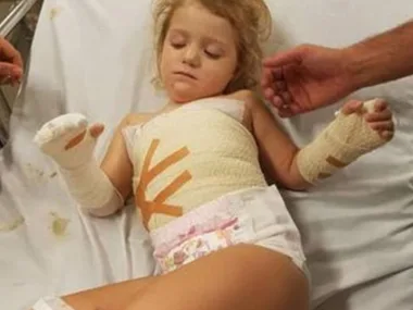 A toddler with bandaged arms and chest lies on a hospital bed, attended by a person’s hands.