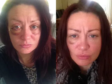 A woman with visible bruising in two different photos shows recovery progress from domestic violence injuries.