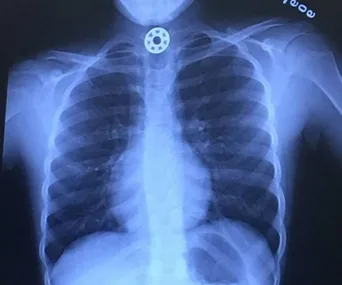 X-ray image showing a fidget spinner part stuck in a girl's throat.
