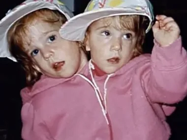Conjoined twins wearing pink hoodies and white hats, looking in different directions with one raising an arm.