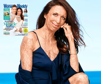 Turia Pitt in a blue dress poses with a smile; inset features a magazine cover with her and partner.