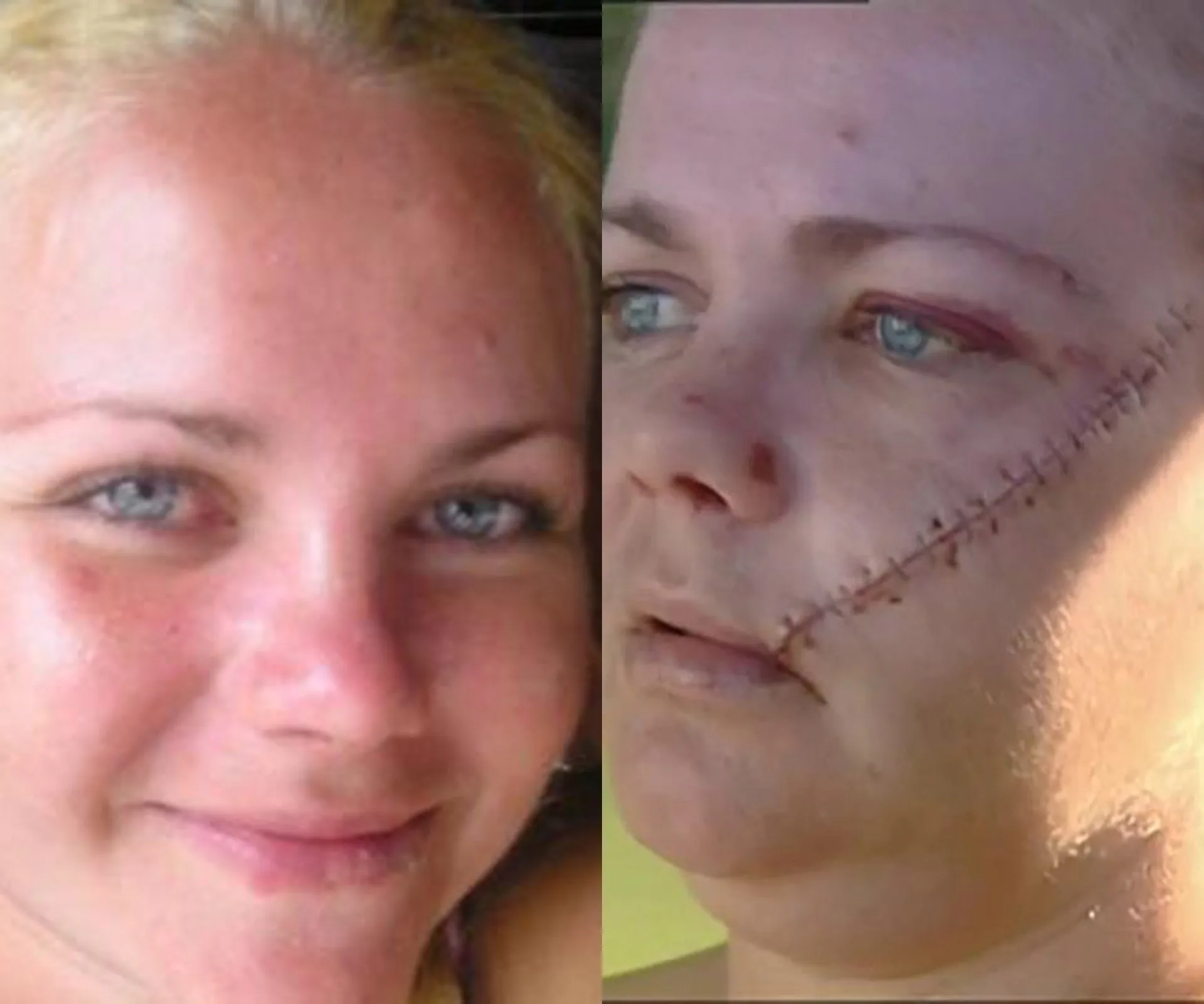 A side-by-side photo of a woman before and after a machete attack, showing facial stitches.
