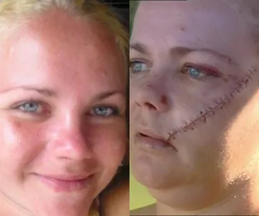 A side-by-side photo of a woman before and after a machete attack, showing facial stitches.