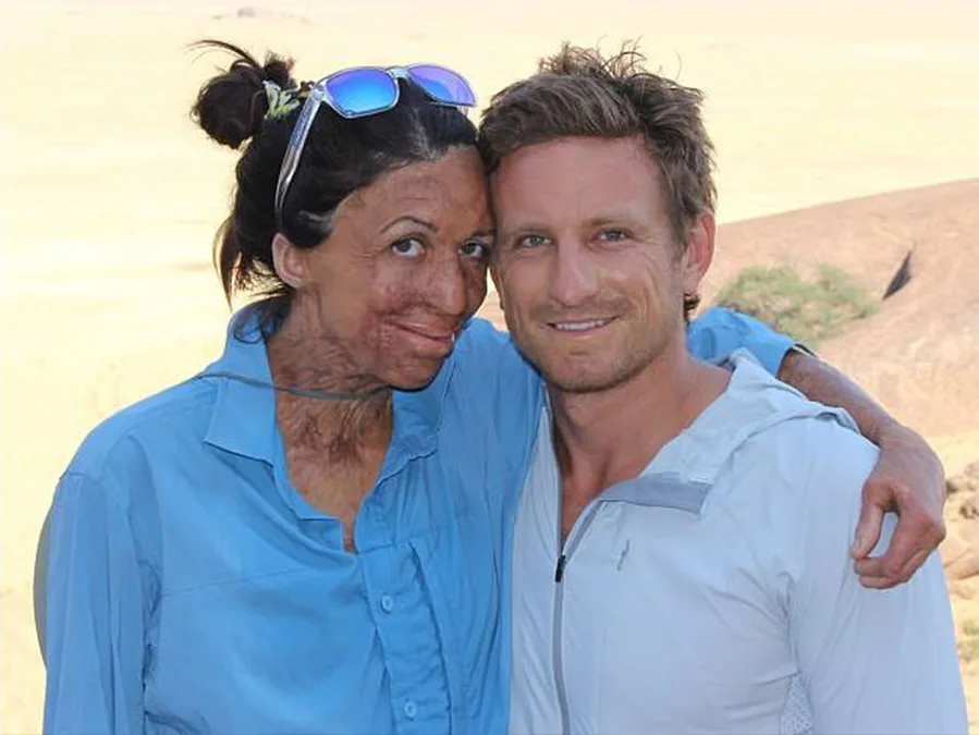 Turia Pitt has finally posted her first baby bump pic