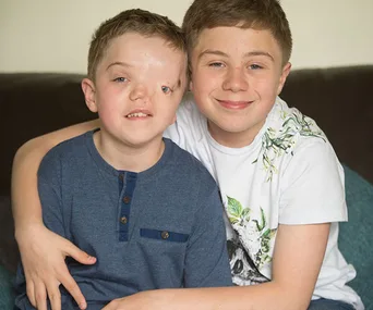 Two boys sitting on a couch, one with a facial difference, smiling and embracing each other warmly.