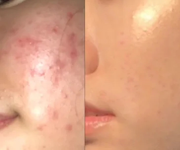 Before and after images showing significant acne improvement on a person's cheek and jawline.