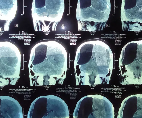 “My daughter is living with half a brain”