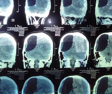 “My daughter is living with half a brain”