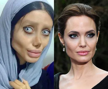 Iranian teenager surgery Angelina Jolie