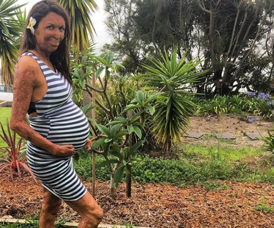 Turia Pitt and Michael Hoskin