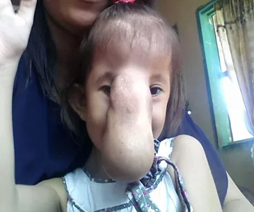 Angel's encephalocele nose growth