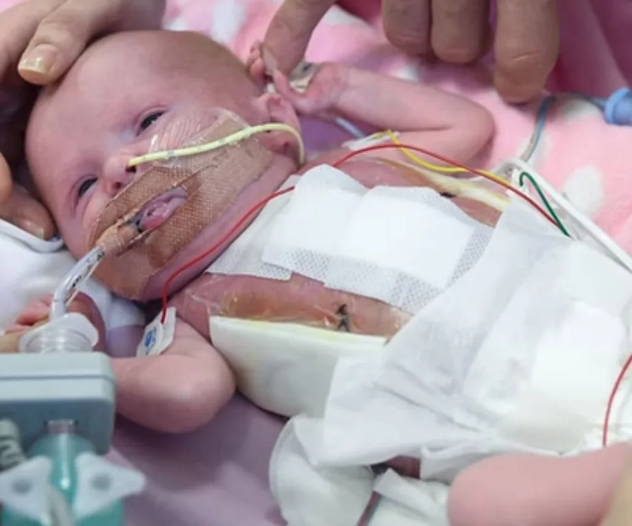 Baby girl born with her heart outside of her chest lives