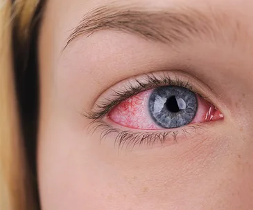 Red, irritated eye with visible blood vessels, illustrating consequence of mistaking superglue for eye drops.