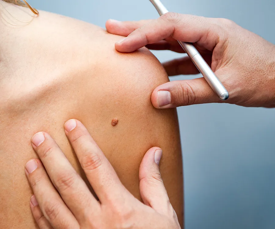 Doctor examining a mole on a patient's shoulder with a dermatoscope.