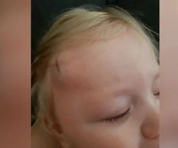 A close-up of a baby with a small cut on the forehead, eyes closed, light blonde hair visible.
