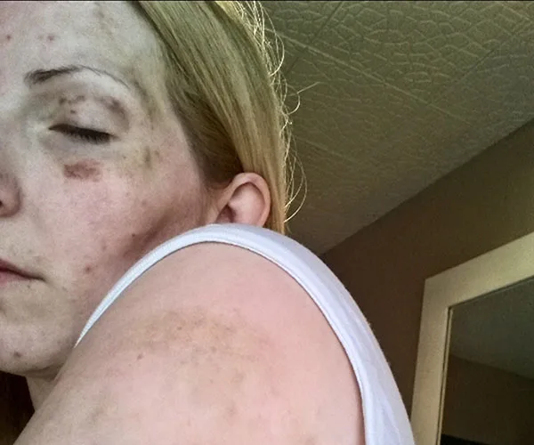 A woman with bruises on her face and shoulder, eyes closed, wearing a white tank top, in a domestic setting.
