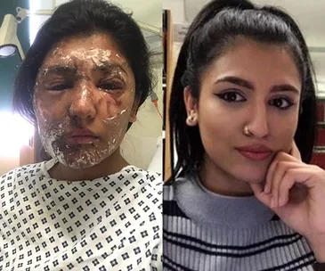 Acid attack recovery: two images of a woman, first injured with cream, second healed and smiling.