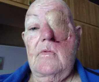 An elderly person with a large growth covering the eye, causing significant facial distortion.