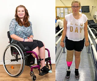 A woman in a wheelchair with a leg amputation and the same woman with a prosthetic leg standing in a rehab facility.