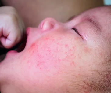 Close-up of a baby with red, irritated skin on the cheek, indicative of eczema.