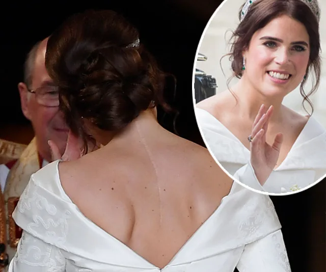 Rear view of a woman in a wedding dress revealing a scoliosis surgery scar on her back; inset shows her smiling and waving.