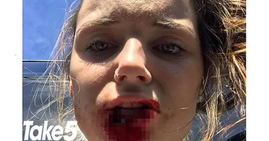 A person with a bruised and injured mouth, looking distressed.