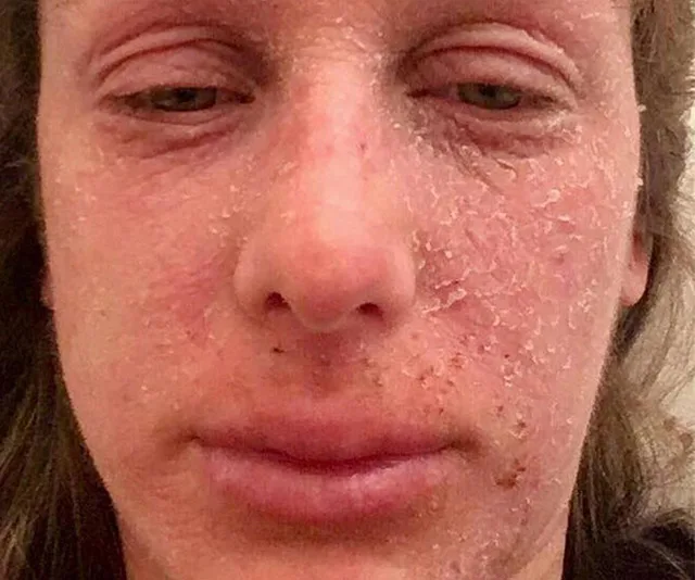 Face with dry, flaky skin due to an eczema flare-up after stopping steroid treatment.