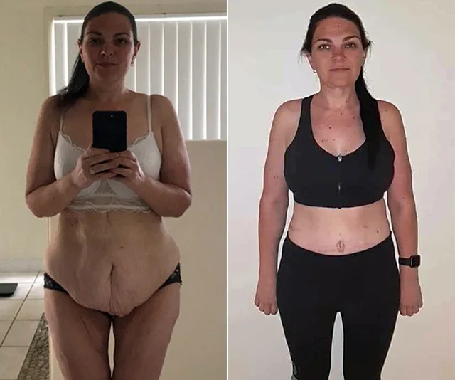 Before and after weight loss and excess skin removal of a woman in workout attire, showing body transformation.
