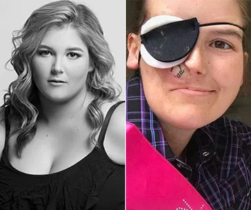 Young woman before and after cancer treatment, one side shows her with an eye patch and a mark on her cheek.