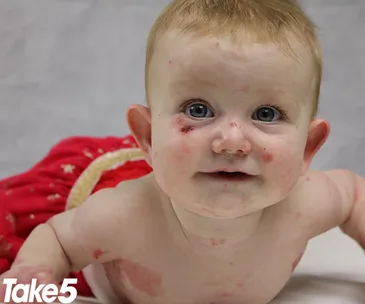 epidermolysis bullosa baby