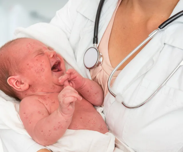 Crying baby with measles rash held by a healthcare professional wearing a stethoscope.