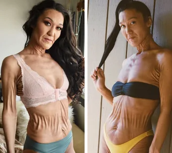 Woman with saggy skin in lingerie, showcasing confidence and unique skin condition.