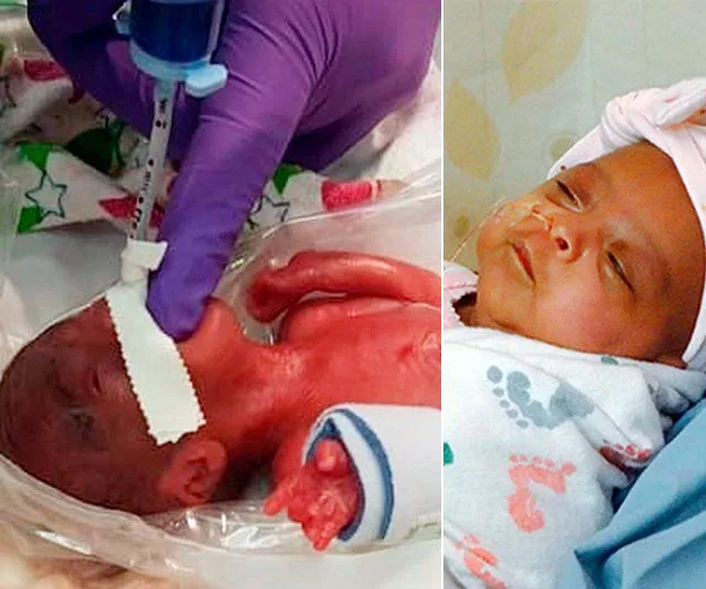 A premature baby in neonatal care and the same baby healthier in a hospital blanket and hat.