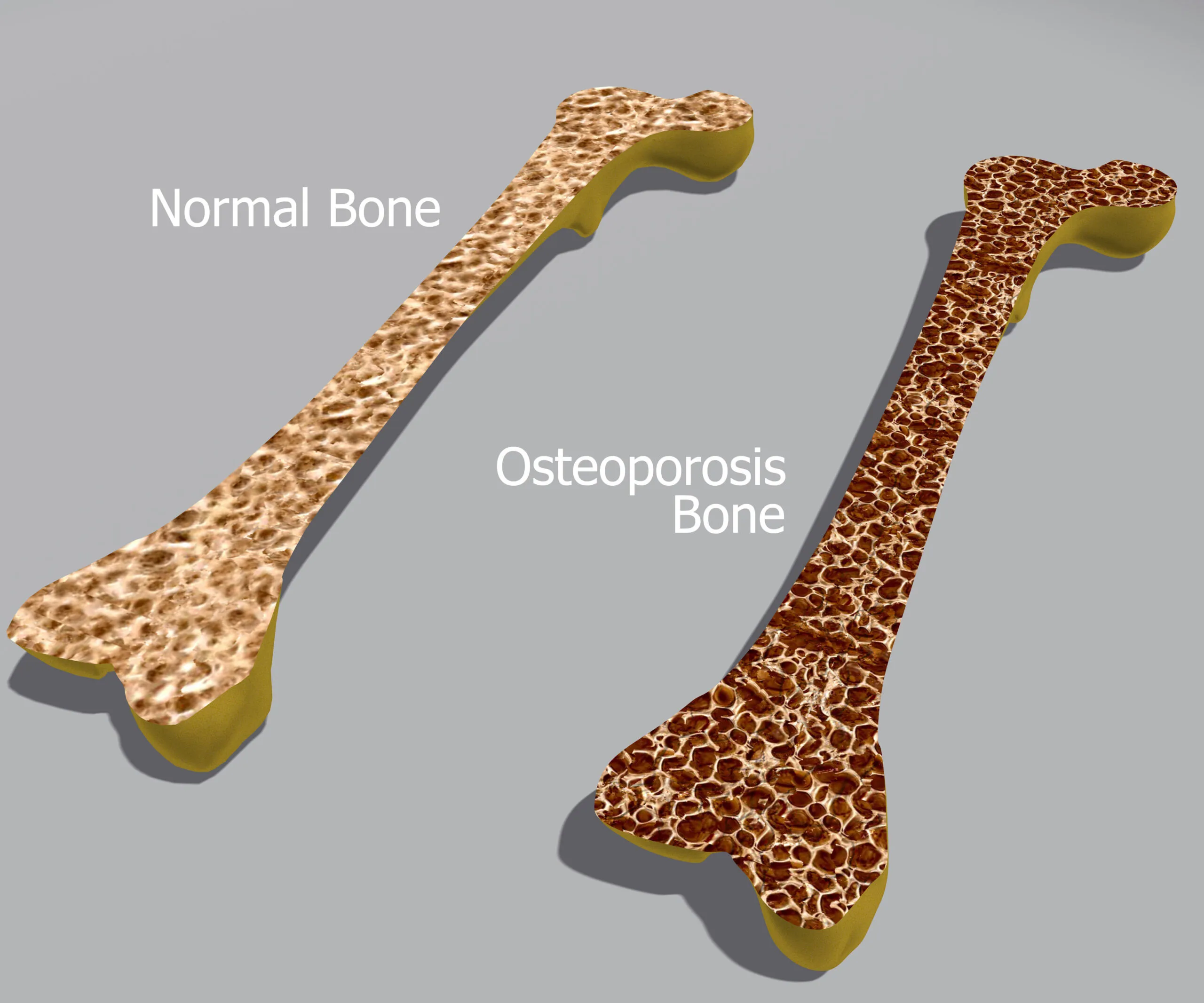 Normal and osteoporosis bone comparison showing bone density differences.