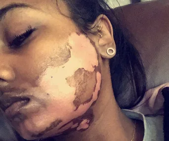 Face with severe burns and discoloration, possibly from a laser hair removal procedure.