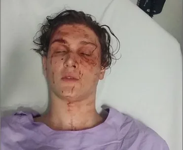 A person with a blood-stained face and closed eyes lying on a hospital bed, wearing a purple gown.