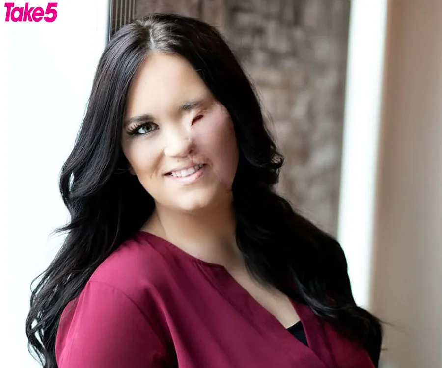 Woman with long dark hair in a maroon top, smiling confidently, showing visible burn scars on her face.
