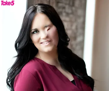 Woman with long dark hair in a maroon top, smiling confidently, showing visible burn scars on her face.