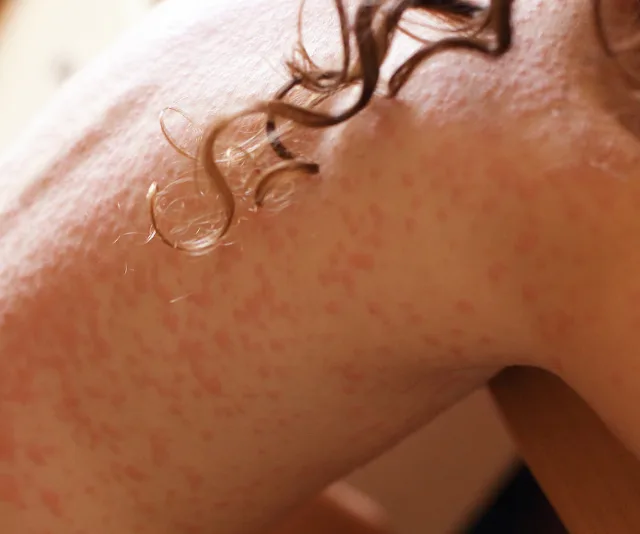 Red rash on child's back, indicating a possible allergic reaction or skin condition.