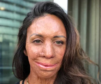 A woman with facial burn scars smiles slightly, hair blowing, standing in front of a building with glass windows.