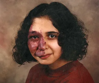 A girl with short, curly hair showing a birthmark associated with Sturge-Weber syndrome on the left side of her face.