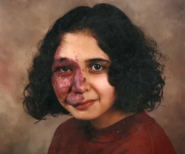Real life: How Sturge Weber Syndrome took over my face