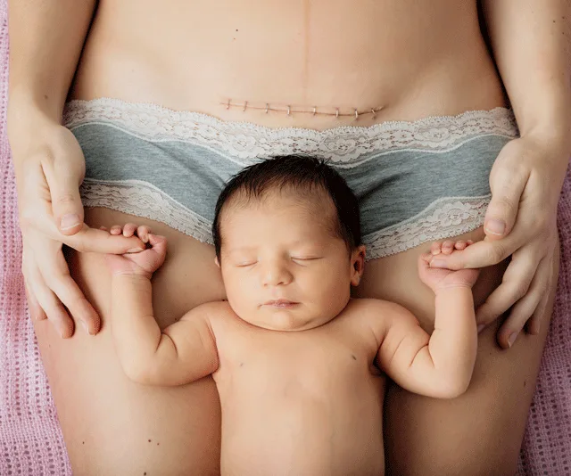 A newborn baby lying on a parent's lap, with a visible C-section scar above.