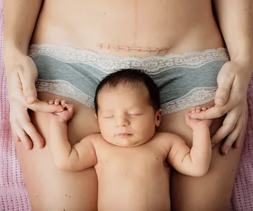 A newborn baby lying on a parent's lap, with a visible C-section scar above.