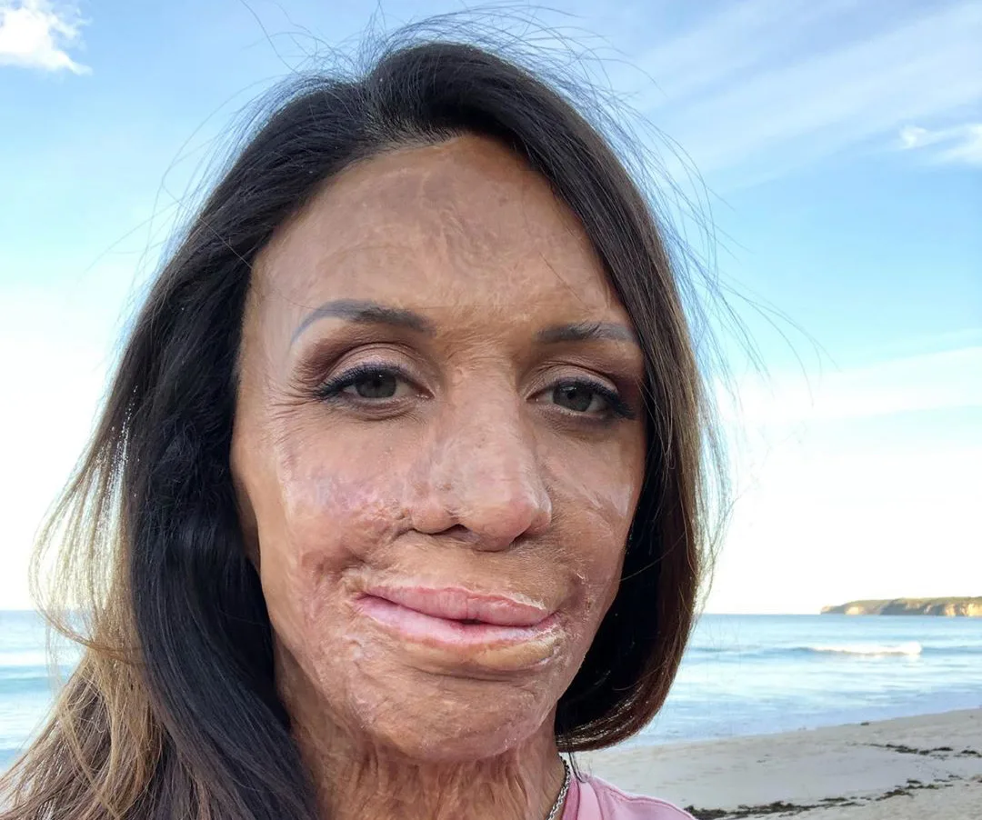 A woman with long hair and burn scars on her face, standing on a beach with the sea in the background.